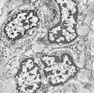 F,31y. | initial glomerular hyalinosis and sclerosis F,31y. | initial glomerular hyalinosis and sclerosis